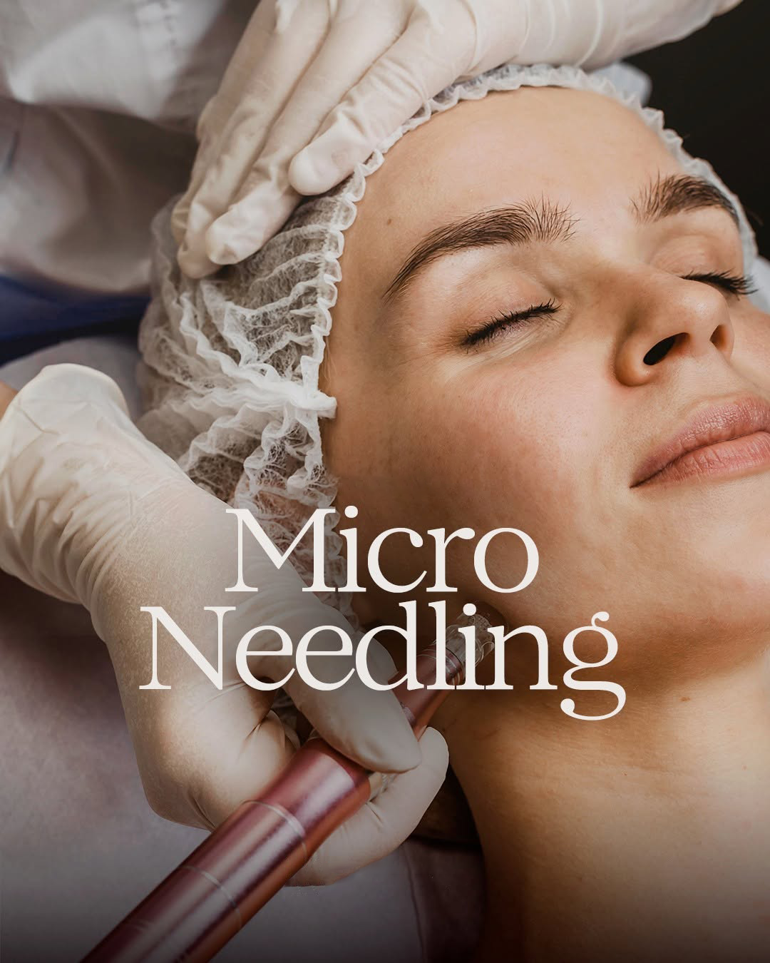 microneedling Aix-en-Provence