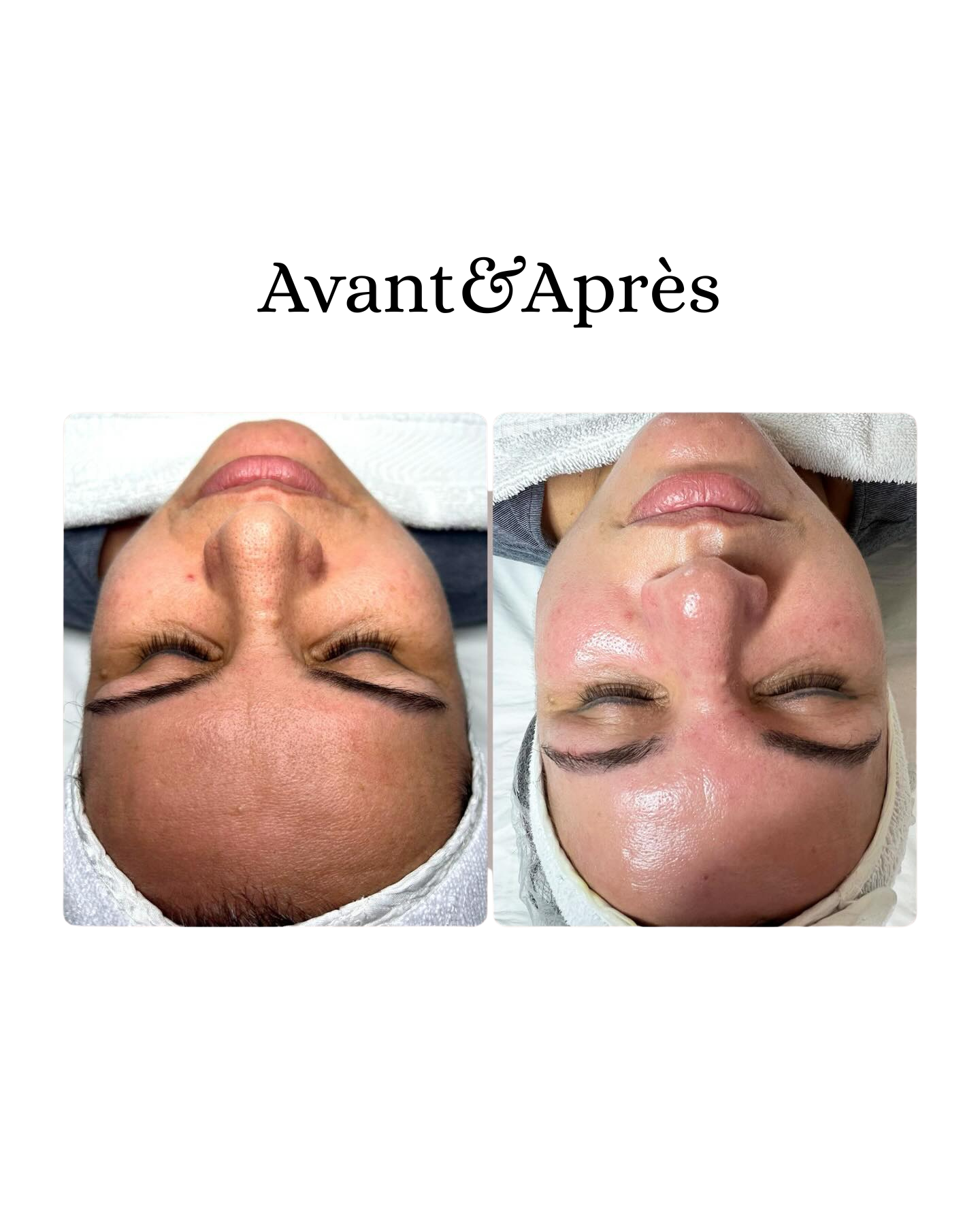 soin du visage Aix-en-Provence - nettoyage peau